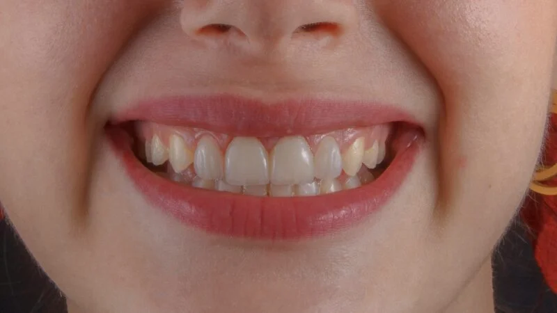 Hassas dişler için en iyi diş macunu hangisi